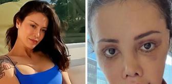 Yüz nakli yaptıran Didem Ceran'ın son hali