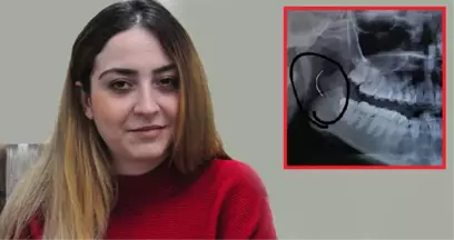 3 Yaşında Bademcik Ameliyat Oldu, Boğazında Unuttukları İğne ile 18 Yıl Yaşadı