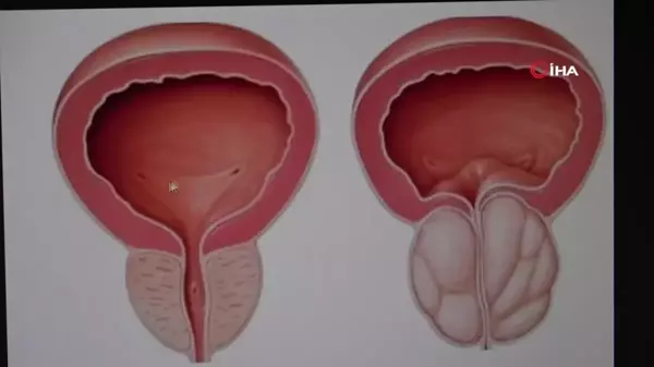 İyi Huylu Prostat Büyümesi Tedavisinde HoLEP Ameliyatı ile Yeni Bir Dönem