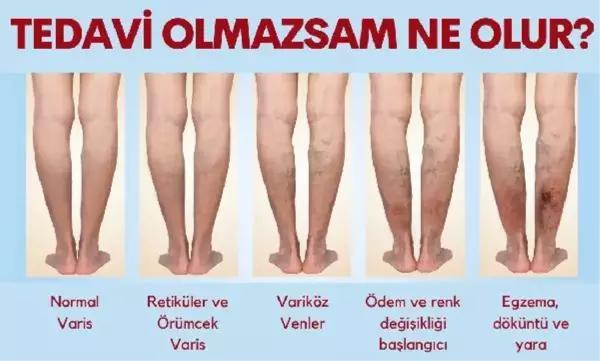 TEDAVİ EDİLMEYEN VARİSE DİKKAT; ÖMÜR BOYU VARİS ÇORABI GİYMEK ZORUNDA KALABİLİRSİNİZ