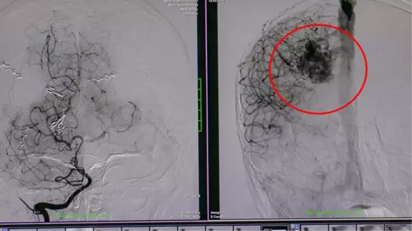 Küçük çocuğun beyninde oluşan damar yumağı, 20 saatlik operasyonla çıkarıldı